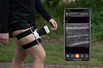 The wearable ultrasound imaging solution combines the wireless freedom of Clarius ultrasound with the security of the ProbeFix Dynamic, enabling limitless research opportunities of bodies in motion.